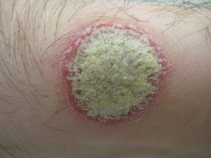 Psoriasis_schuppenflechte Psoriasis - Schuppenflechte
