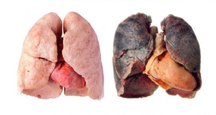 Raucherkrankheiten der Atmungsorgane: Abbildung einer gesunden Lunge und einer Raucherlungeder Atemwege: Abbildung einer gesunden Lunge und einer Raucherlunge