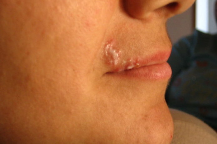 lippenherpes lippenherpes