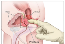 Proscht, zum Wohl – Prostatakrebs